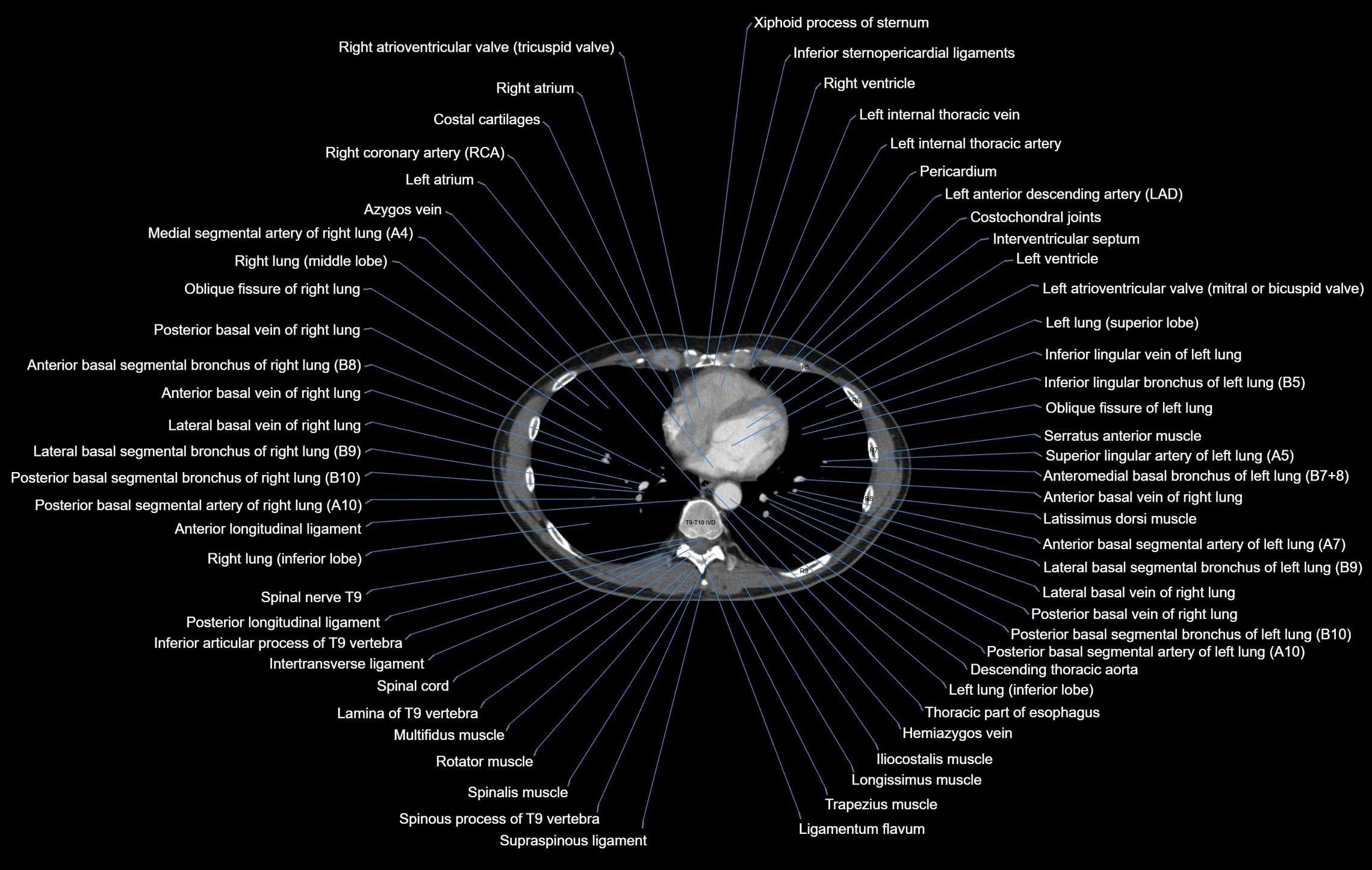 CT chest (thorax) labelled axial cross sectional anatomy radiology image-00080.webp